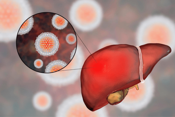 liver cancer