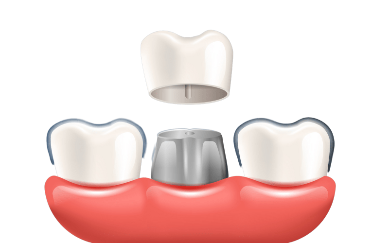 dental-cap