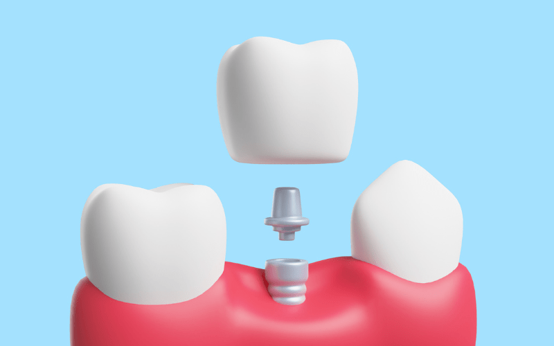 dental-crown